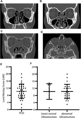 Molecular defects in primary ciliary dyskinesia are associated with agenesis of the frontal and sphenoid paranasal sinuses and chronic rhinosinusitis